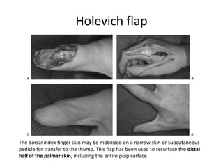 Holevich flap
The dorsal index finger skin may be mobilized on a narrow skin or subcutaneous
pedicle for transfer to the thumb. This flap has been used to resurface the distal
half of the palmar skin, including the entire pulp surface
 