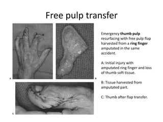 Free pulp transfer
Emergency thumb pulp
resurfacing with free pulp flap
harvested from a ring finger
amputated in the same
accident.
A: Initial injury with
amputated ring finger and loss
of thumb soft tissue.
B: Tissue harvested from
amputated part.
C: Thumb after flap transfer.
 