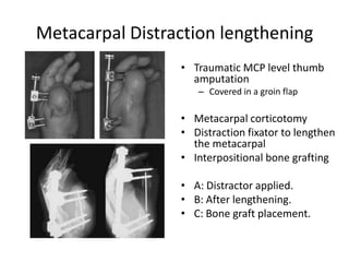Metacarpal Distraction lengthening
• Traumatic MCP level thumb
amputation
– Covered in a groin flap
• Metacarpal corticotomy
• Distraction fixator to lengthen
the metacarpal
• Interpositional bone grafting
• A: Distractor applied.
• B: After lengthening.
• C: Bone graft placement.
 
