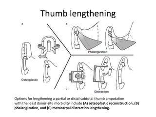 Thumb lengthening
Options for lengthening a partial or distal subtotal thumb amputation
with the least donor-site morbidity include (A) osteoplastic reconstruction, (B)
phalangization, and (C) metacarpal distraction lengthening.
 