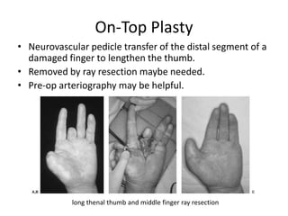 On-Top Plasty
• Neurovascular pedicle transfer of the distal segment of a
damaged finger to lengthen the thumb.
• Removed by ray resection maybe needed.
• Pre-op arteriography may be helpful.
long thenal thumb and middle finger ray resection
 