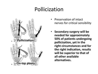 Pollicization
• Preservation of intact
nerves for critical sensibility
• Secondary surgery will be
needed for approximately
50% of patients undergoing
pollicization, yet in the
right circumstances and for
the right indication, results
will be superior to that of
all other available
alternatives.
 