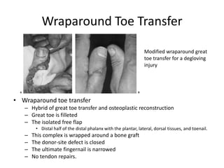 Wraparound Toe Transfer
• Wraparound toe transfer
– Hybrid of great toe transfer and osteoplastic reconstruction
– Great toe is filleted
– The isolated free flap
• Distal half of the distal phalanx with the plantar, lateral, dorsal tissues, and toenail.
– This complex is wrapped around a bone graft
– The donor-site defect is closed
– The ultimate fingernail is narrowed
– No tendon repairs.
Modified wraparound great
toe transfer for a degloving
injury
 