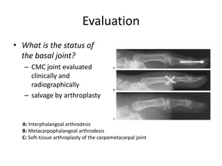 Evaluation
• What is the status of
the basal joint?
– CMC joint evaluated
clinically and
radiographically
– salvage by arthroplasty
A: Interphalangeal arthrodesis
B: Metacarpophalangeal arthrodesis
C: Soft-tissue arthroplasty of the carpometacarpal joint
 