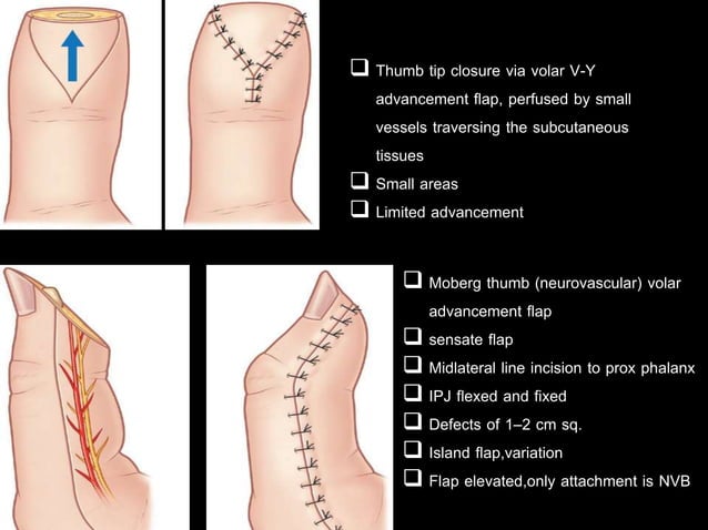 Thumb reconstruction | PPT