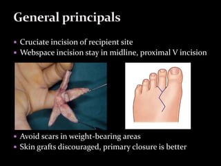 Thumb reconstruction | PPTX
