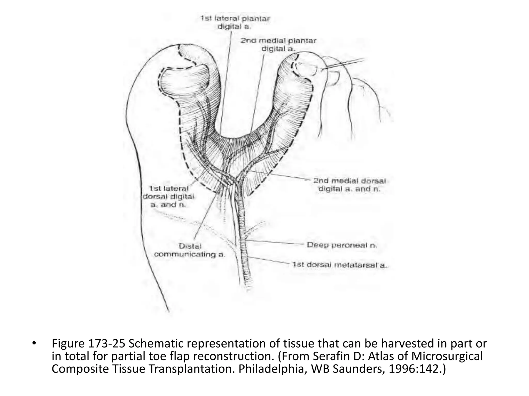 Thumb reconstruction by microvascular methods | PPT