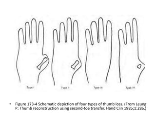 Thumb reconstruction by microvascular methods | PPTX