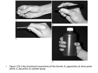 Thumb reconstruction by microvascular methods