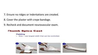 THUMB SPICA SPLINT 2.pptx