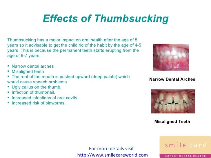 Thumbsucking At what age should it stop?