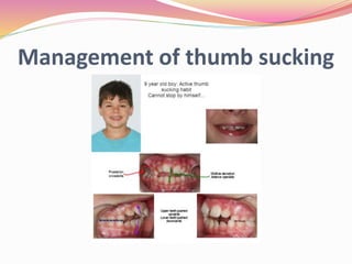 Management of thumb sucking
 
