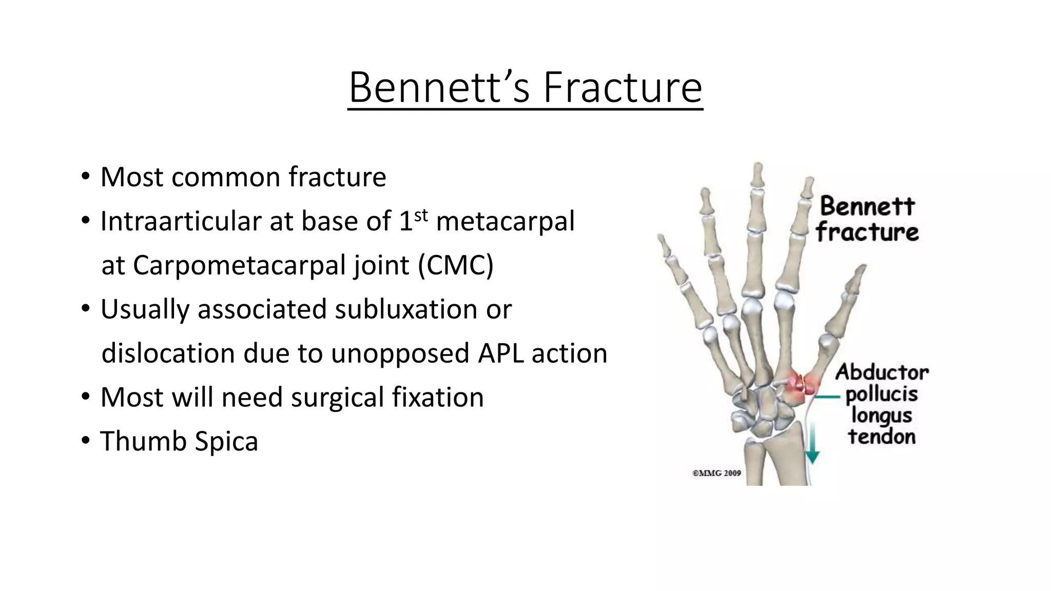 Thumbs up! Thumb injuries and their management | PPTX
