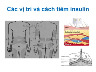 Các vị trí và cách tiêm insulin
 