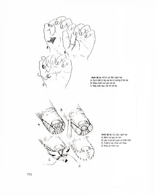 Hình 36.1b. Cut đáu ngon tay
A: Mòm cụt sau tai nan
B: Lấy 2 vạt tam giác có chán nuôi
C: Trượt 2 val, kháu với nhau
D: Khâu lai móm cut
?72
 