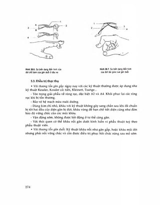— 1
Hình 36.6. Sự biến dạng điển hinh cùa
đứt chỗ bám của gân duỗi ờ dầu xa
Hinh 36.7. Sư biến dang điển hình
của đứt dài giữa của gán duỗi
5.3. Điều trị thực thụ
• Vói thương tổn gân gấp-, ngày nay với các kỹ thuật thường được áp dụng như
kỹ thuật Kessler, Kessler cải tiếh, Kleinert, Tsunge...
- Tôn trọng giải phẫu ve ròng rọc, đặc biệt A2 và A4. Khôi phục lại các ròng
rọc khi bị tôn thương.
- Bảo vệ hệ mạch máu nuôi dưỡng.
- Dùng kim chỉ nhỏ, khâu với kỹ thuật không gây sang chấn sau khi đã chuấn
bị tốt hai đâu cùa diện gân bị đứt, khâu vòng đê hạn chế tiết diện cũng như đảm
bảo độ vững chắc của các mũi khâu.
- Vận động sóm, không được bất động ở tư thế căng gân.
- Với thói quen có thế khâu nối gân dưới kính hiển vi phẫu thuật tuỳ theo
phẫu thuật viên.
• Với thương tôn gân duỗi: Kỹ thuật khâu nôi như gân gâp, hoặc khâu mũi dời
nhưng phải nối vững chắc và cần được điều trị phục hồi chức năng sau mổ sóm.
274
 
