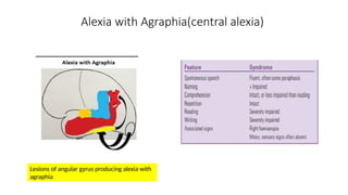 Alexia with Agraphia(central alexia)
Lesions of angular gyrus producing alexia with
agraphia
 