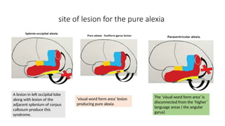 site of lesion for the pure alexia
A lesion in left occipital lobe
along with lesion of the
adjacent splenium of corpus
callosum produce this
syndrome.
‘visual word form area’ lesion
producing pure alexia
The ‘visual word form area’ is
disconnected from the ‘higher’
language areas ( the angular
gyrus)
 