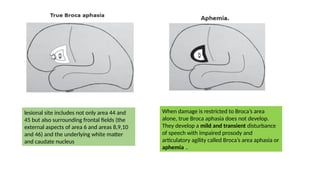 lesional site includes not only area 44 and
45 but also surrounding frontal fields (the
external aspects of area 6 and areas 8,9,10
and 46) and the underlying white matter
and caudate nucleus
When damage is restricted to Broca’s area
alone, true Broca aphasia does not develop.
They develop a mild and transient disturbance
of speech with impaired prosody and
articulatory agility called Broca’s area aphasia or
aphemia ..
 