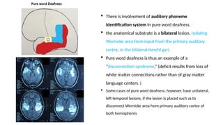  There is involvement of auditory phoneme
identification system in pure word deafness.
 the anatomical substrate is a bilateral lesion, isolating
Wernicke area from input from the primary auditory
cortex, in the bilateral Heschl gyri.
 Pure word deafness is thus an example of a
“disconnection syndrome,” (deficit results from loss of
white matter connections rather than of gray matter
language centers. )
 Some cases of pure word deafness, however, have unilateral,
left temporal lesions, if the lesion is placed such as to
disconnect Wernicke area from primary auditory cortex of
both hemispheres
 