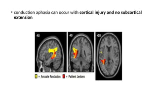 • conduction aphasia can occur with cortical injury and no subcortical
extension
 