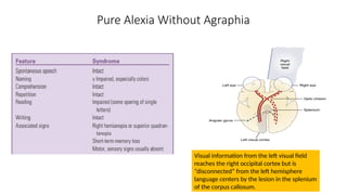 Pure Alexia Without Agraphia
Visual information from the left visual field
reaches the right occipital cortex but is
“disconnected” from the left hemisphere
language centers by the lesion in the splenium
of the corpus callosum.
 