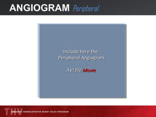 ANGIOGRAM  Peripheral Include here the  Peripheral Angiogram AVI file  Movie 