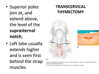 TRANSCERVICAL
THYMECTOMY
• Superior poles
join at, and
extend above,
the level of the
suprasternal
notch;
• Left lobe usually
extends higher
and is seen first
behind the strap
muscles
 