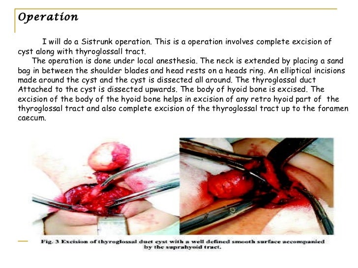 Thyroglossalcyst