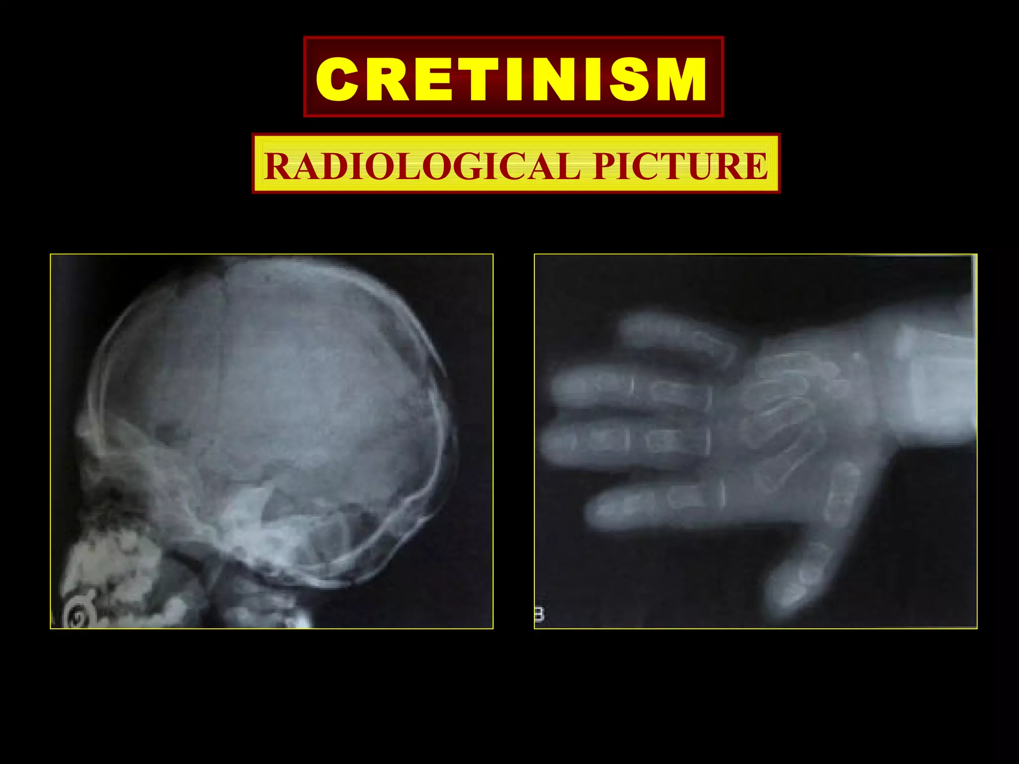 CRETINISM
RADIOLOGICAL PICTURE
 