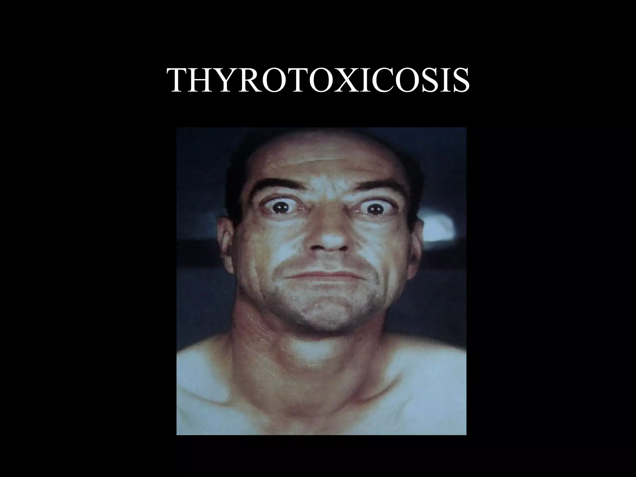THYROTOXICOSIS
 