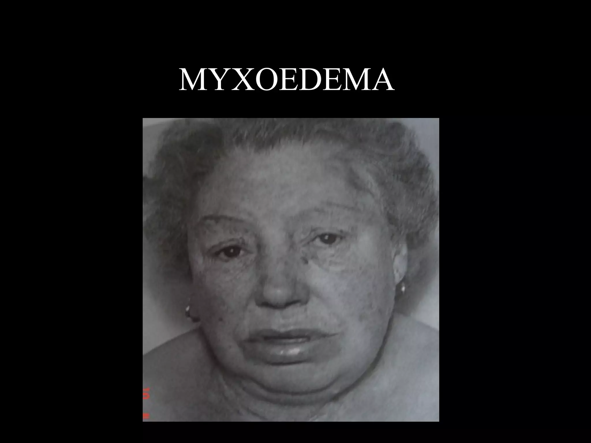 MYXOEDEMA
 