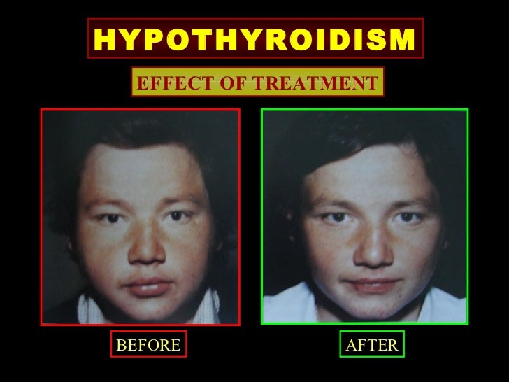 Medical management of Thyroid disease