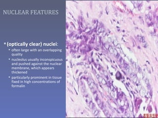 NUCLEAR FEATURES




 (optically clear) nuclei:
   often large with an overlapping
    quality
   nucleolus usually inconspicuous
    and pushed against the nuclear
    membrane, which appears
    thickened
   particularly prominent in tissue
    fixed in high concentrations of
    formalin
 