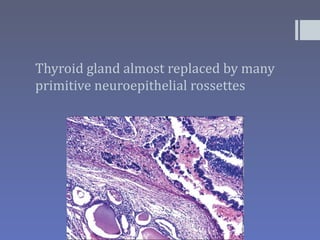 Thyroid gland almost replaced by many
primitive neuroepithelial rossettes
 