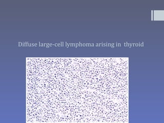 Diffuse large-cell lymphoma arising in thyroid
 