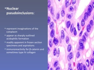  Nuclear
  pseudoinclusions:



 represent invaginations of the
  cytoplasm
 appear as sharply outlined
  acidophilic formation
 readily apparent in frozen section
  specimens and aspirations
 immunoreactivity for β-catenin and
  sometimes type IV collagen
 