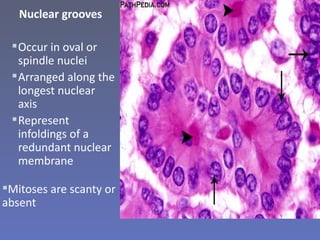 Nuclear grooves

  Occur in oval or
   spindle nuclei
  Arranged along the
   longest nuclear
   axis
  Represent
   infoldings of a
   redundant nuclear
   membrane

Mitoses are scanty or
absent
                          intranuclear grooves (400×).
 
