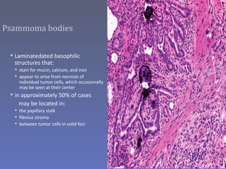 Psammoma bodies


  Laminatedated basophilic
   structures that:
   stain for mucin, calcium, and iron
   appear to arise from necrosis of
    individual tumor cells, which occasionally
    may be seen at their center
  in approximately 50% of cases
     may be located in:
   the papillary stalk
   fibrous stroma
   between tumor cells in solid foci
 