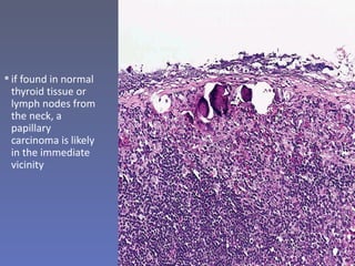 Psammoma body formation in papillary
                        carcinoma beneath the capsule of a
 if found in normal         cervical lymph node, without identifiable
  thyroid tissue or
  lymph nodes from
  the neck, a
  papillary
  carcinoma is likely
  in the immediate
  vicinity
 