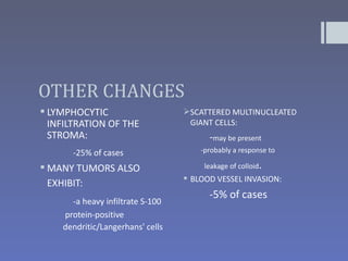 OTHER CHANGES
 LYMPHOCYTIC                     SCATTERED MULTINUCLEATED
  INFILTRATION OF THE              GIANT CELLS:
  STROMA:                               -may be present
      -25% of cases                   -probably a response to

 MANY TUMORS ALSO                     leakage of colloid.
                                   BLOOD VESSEL INVASION:
  EXHIBIT:
                                        -5% of cases
      -a heavy infiltrate S-100
    protein-positive
    dendritic/Langerhans' cells
 