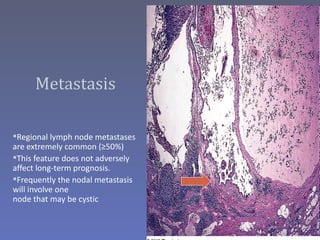 Metastasis

Regional lymph node metastases
are extremely common (≥50%)
This feature does not adversely
affect long-term prognosis.
Frequently the nodal metastasis
will involve one
node that may be cystic
 