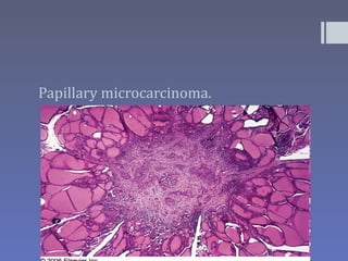 Papillary microcarcinoma.
 