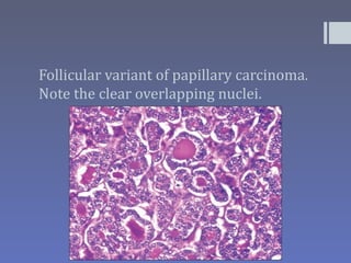 Follicular variant of papillary carcinoma.
Note the clear overlapping nuclei.

                  PIPELLE,
 