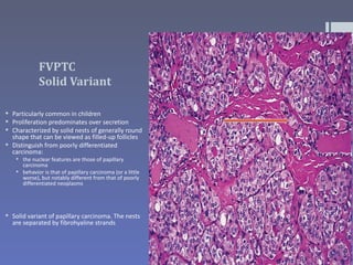 FVPTC
             Solid Variant

 Particularly common in children
 Proliferation predominates over secretion
 Characterized by solid nests of generally round
  shape that can be viewed as filled-up follicles
 Distinguish from poorly differentiated
  carcinoma:
    the nuclear features are those of papillary
     carcinoma
    behavior is that of papillary carcinoma (or a little
     worse), but notably different from that of poorly
     differentiated neoplasms




 Solid variant of papillary carcinoma. The nests
  are separated by fibrohyaline strands
 