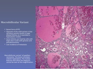 Macrofollicular Variant

   Rarest form of PTC
   Opposite of the solid variant in that
    secretory activity results in large
    dilated follicles so it resembles a
    hyperplastic nodule
   Some follicles are lined by cells with
    large clear nuclei with grooves and
    pseudoinclusions
   Low incidence of metastasis




  Macrofollicular variant’ of papillary
   carcinoma. This lesion simulates
   nodular hyperplasia. The nuclear
   features that allow the diagnosis
   cannot be seen at this magnification.
 