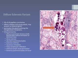 Diffuse Sclerosis Variant

 3% of all papillary carcinomas
 affects children and young adults, may
  present as bilateral goiter.
 permeates the gland outlining the
  intraglandular lymphatics.
 Characterized by:
    diffuse involvement of one or both
     thyroid lobes without formation of
     dominant mass
    dense sclerosis
    abundant psammoma bodies
    extensive solid foci
    squamous metaplasia
    heavy lymphocytic infiltration
    extensive lymph vessel permeation
    Numerous psammoma bodies are found
 