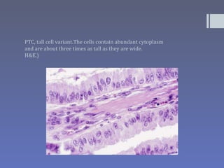 PTC, tall cell variant.The cells contain abundant cytoplasm
and are about three times as tall as they are wide.
H&E.)
 