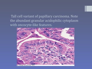 Tall cell variant of papillary carcinoma. Note
the abundant granular acidophilic cytoplasm
with oncocyte-like features.
 