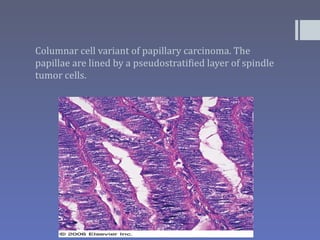 Columnar cell variant of papillary carcinoma. The
papillae are lined by a pseudostratified layer of spindle
tumor cells.
 